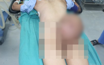 Người đàn ông hàng chục năm không thể nằm ngửa bởi khối u gần 4kg… ở mông