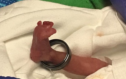Sức sống kỳ diệu của em bé sinh non 21 tuần tuổi nặng có 400g, bàn chân lọt thỏm trong chiếc nhẫn