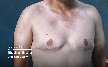 Mỹ: Hàng ngàn nam giới có ngực bự bất thường do sử dụng thuốc an thần