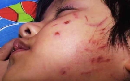 Giáo viên bỏ lớp, bé gái 4 tuổi bị bạn đánh “hội đồng”?