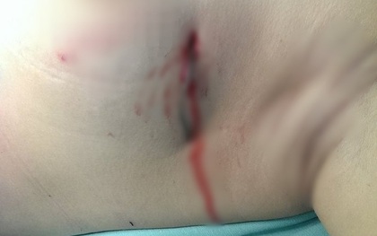 Hà Nội: Đang đi đường, người phụ nữ trẻ nguy kịch vì bị kim loại nhọn cắm sâu vào ngực