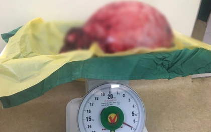 Người phụ nữ mang khối u nặng 12kg trong bụng như mang bầu suốt nhiều năm