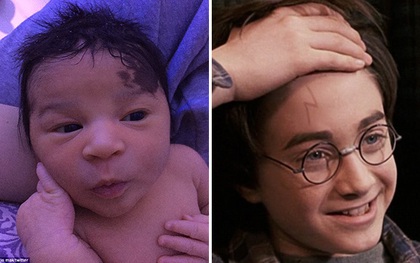 Gặp gỡ Harry Potter phiên bản đời thực mới chào đời