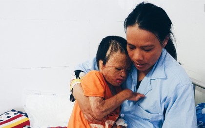 Cậu bé 5 tuổi bị bỏng đến biến dạng vì anh trai nướng hạt điều cạnh đống rơm
