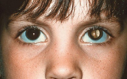 Tìm hiểu căn bệnh ung thư quái ác khiến đôi mắt trẻ con lấp lánh như kim cương