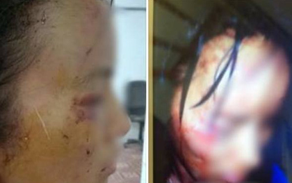 Phú Thọ: Cô giáo trẻ bị chồng đánh đập thương tích đầy người