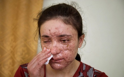 Gương mặt chằng chịt sẹo của cô gái sau 5 lần trốn chạy khỏi những tay buôn bán nô lệ tình dục IS