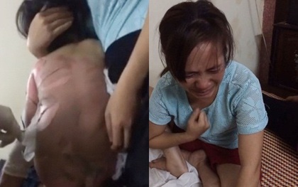 Xót xa hình ảnh bé gái 3 tuổi bị bỏng bong tróc toàn bộ da ở lưng khi ngã vào chậu nước sôi