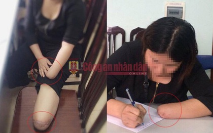 Người phụ nữ thuê chặt chân tay để hưởng bảo hiểm 3 tỷ trong khi đang mang án tù do môi giới mại dâm
