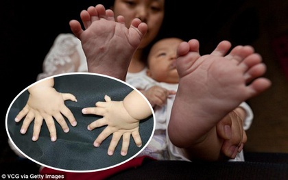 Bé trai chào đời với dị tật 31 ngón cả tay và chân