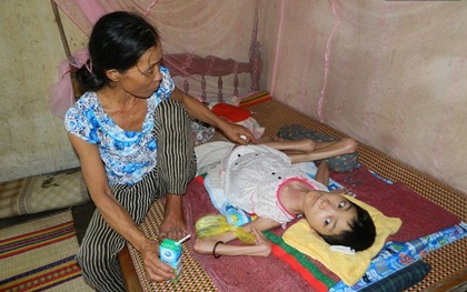 Cô gái mắc bệnh lạ suốt 26 năm nằm một chỗ, lở loét khắp người