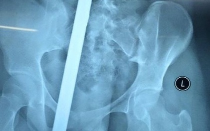 Nữ sinh 16 tuổi bị thanh sắt đâm xuyên người