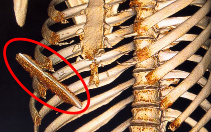 Thanh niên bị lưỡi dao 10 cm đâm lút ngực, thủng gan vẫn may mắn thoát chết