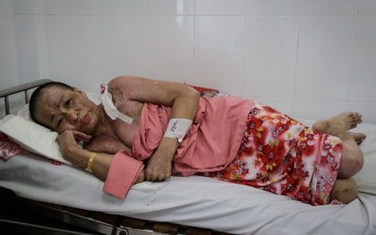 Không móc cống nghẹt, người phụ nữ ở Sài Gòn bị tạt nồi thịt sôi vào người gây bỏng nặng