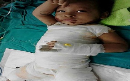 Mẹ đi vệ sinh, bé gái 2 tuổi bị cả nồi canh đang sôi đổ lên người