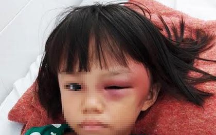 Bé gái bị mẹ kế đánh sưng mắt, châm thuốc lá bỏng tay