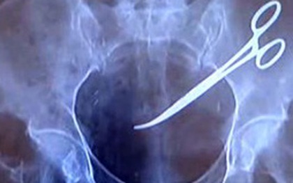 Bắc Kạn: Bác sĩ để quên kéo trong bụng bệnh nhân 18 năm