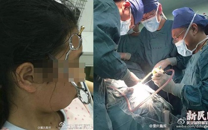 Bắt con làm bài tập không được, cha lỡ tay phi kéo cắm vào đầu con gái