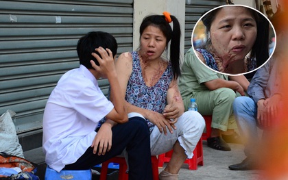 Người phụ nữ vá xe mang những vết sẹo khủng khiếp vì bị tạt axit: Tôi không được nghĩ đến cái chết, nên phải sống!