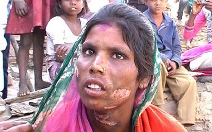 Ấn Độ: Nàng dâu trẻ bị gia đình chồng tra tấn dã man vì một cuộc gọi lỡ