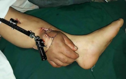 Bàn tay "mọc" lên ở cổ chân và sự thật đằng sau đó