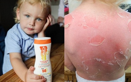 Dùng kem chống nắng SPF 50 đi dã ngoại, bé trai 3 tuổi bị cháy nắng và phồng rộp nghiêm trọng