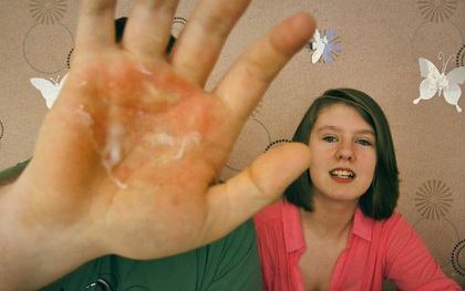 Giới trẻ thi nhau xát muối lên da, dùng đá lạnh ép chặt để chứng tỏ bản lĩnh