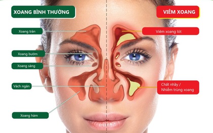 Cẩn thận với các triệu chứng của viêm xoang để không biến bệnh trở thành mãn tính