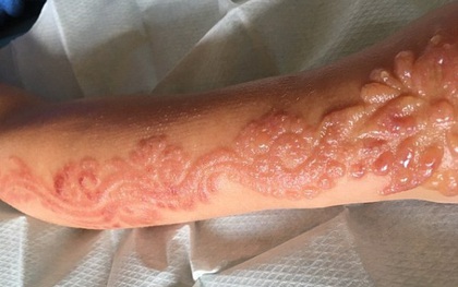 Xăm henna ở tay trong chuyến du lịch Ai Cập, bé gái nhận hậu quả khủng khiếp