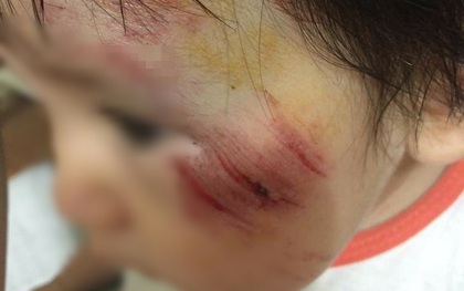 Hà Nội: Truy tìm nam thanh niên phóng mô tô tông bé gái 11 tháng trầy xước mặt rồi bỏ chạy