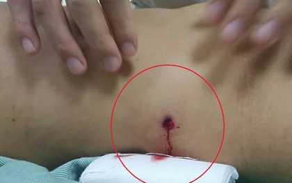 Vụ hai nhóm nổ súng hỗn chiến khiến cô gái thủng đại tràng tại Hà Nội: Công an triệu tập một số đối tượng