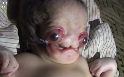 Em bé dị tật chào đời với đôi mắt lồi đỏ ngầu khiến nhiều người sợ hãi