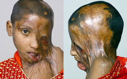 Bố tạt axit đánh ghen với mẹ, bé gái 4 tuổi trở thành nạn nhân đáng thương nhất với khuôn mặt hoàn toàn biến dạng