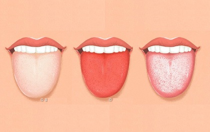 Lưỡi có 4 biểu hiện này, hãy đi kiểm tra sức khoẻ cấp tốc
