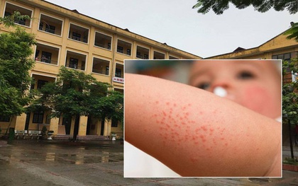 Hà Nội: 10 học sinh nổi mẩn ngứa, cay mắt sau khi nhà trường phun thuốc chống sốt xuất huyết