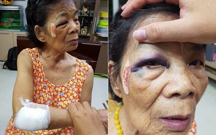 Hà Nội: Bà cụ 80 tuổi bị ô tô đâm bầm tím mắt và tay, tài xế vờ xuống xem rồi viện lý do để bỏ chạy