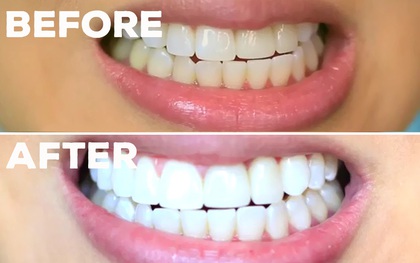 Các bạn trẻ trên thế giới đang dùng những phương pháp tẩy trắng răng gì?