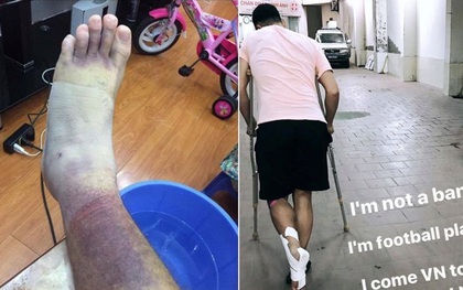 Thủ môn Việt kiều Lâm "Tây" lộ ảnh chân bầm tím khủng khiếp sau vụ bị hành hung