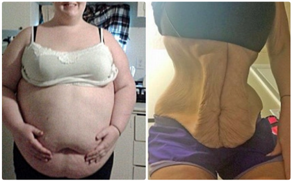 Giảm liền 105kg trong vòng 1 tháng, bụng của người mẹ trẻ thành ra như thế này đây