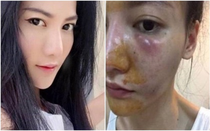 Tiêm trắng da suốt 6 năm, cô gái xinh đẹp nhận gương mặt biến dạng cùng làn da phồng rộp