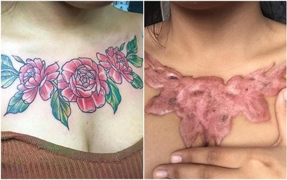 Xóa hình xăm hoa hồng "khủng" trên ngực, nữ sinh viên Thái Lan phải nhận cái kết đau đớn