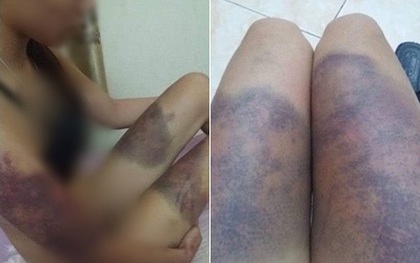 Hà Nội: Cô gái trẻ “tố” bị bạn trai ghen tuông, đánh đập thâm tím hết cả người