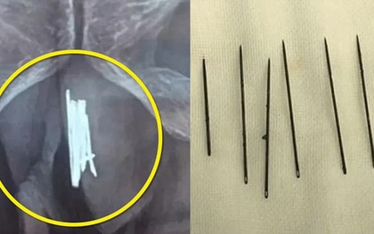 Trung Quốc: Nhét 15 kim khâu vào vùng kín để thỏa mãn, người đàn ông phải nhập viện trong tình trạng nguy kịch