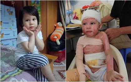 Hành trình hồi phục kỳ diệu của bé gái 5 tuổi bị bỏng cồn do nhân viên nhà hàng sơ ý