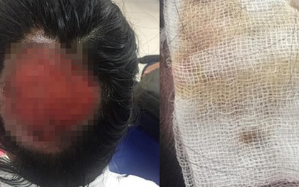 Tai nạn nghiêm trọng khi uốn tóc: Tóc cuốn vào ống dẫn nhiệt, nữ bác sĩ bỏng sâu, tróc gần như toàn bộ da đầu