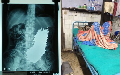 Bệnh nhân đau bụng hai tháng trời, các bác sĩ sững người khi thấy thứ nằm trong bụng anh ta