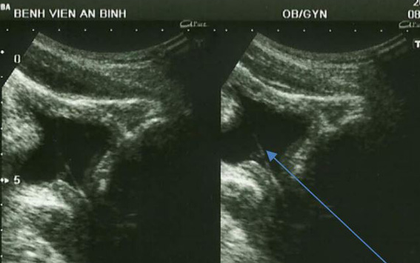 Tự khều sỏi thận, người đàn ông bị vướng cỏ trong… “chỗ hiểm”