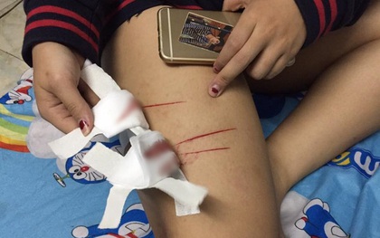 Công an vào cuộc xác minh vụ nữ sinh bị rạch đùi trên đường phố Sài Gòn