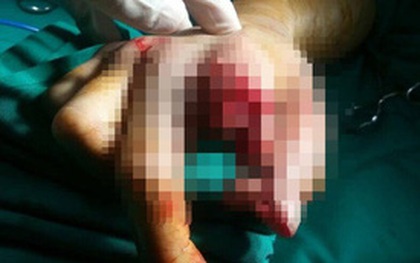 TP.HCM: Một công nhân bị máy xay thịt cắt đứt ngón tay