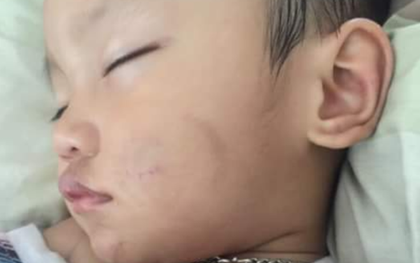 Cháu bé hai tuổi nghi bị bạn trai của mẹ ruột đánh đập